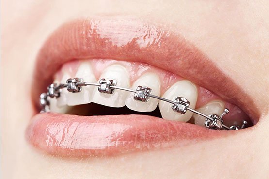 cheap Orthodontics canley heights