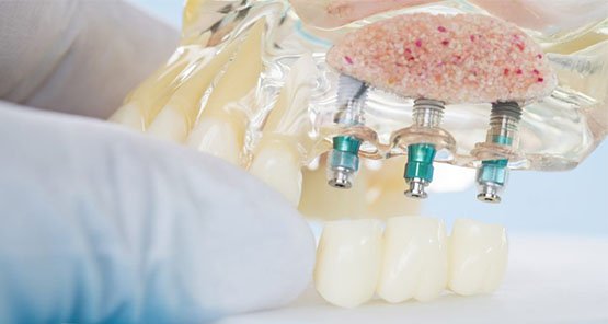 dental implants blurb canley heights