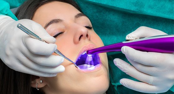 fissure sealants canley heights