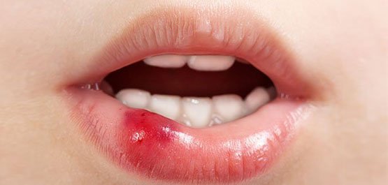 soft tissues injuries in the mouth canley heights