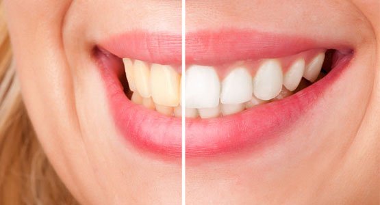tooth whitening canley heights