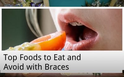 Top Foods to Eat and Avoid with Braces from Canley Heights Dental Care