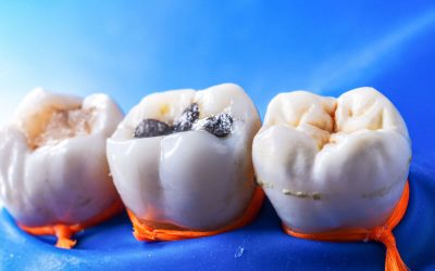 How to Pick the Right Dental Fillings in Canley Heights