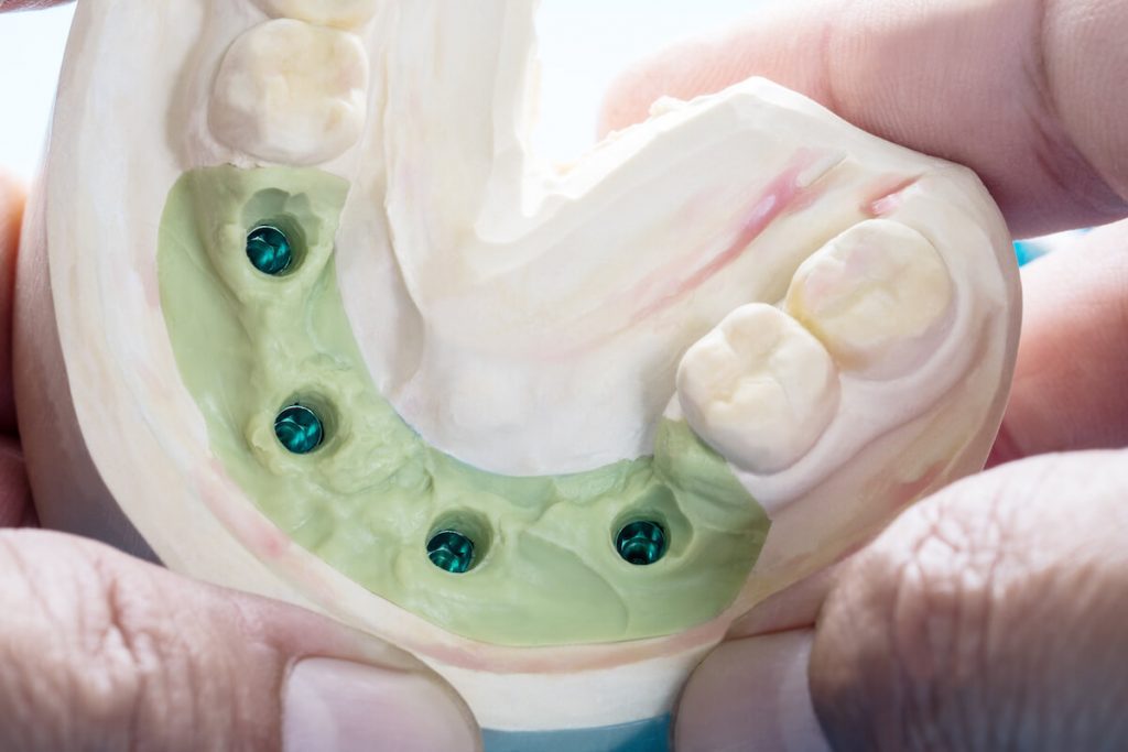 dental implants in canley heights should you shop around