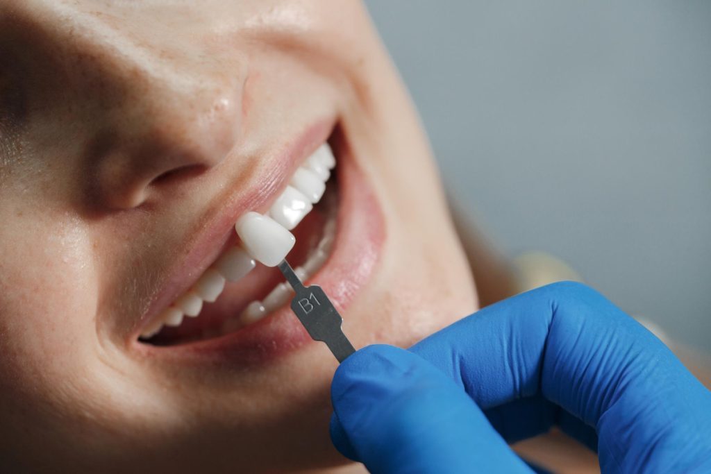 what to expect when getting dental veneers in canley heights