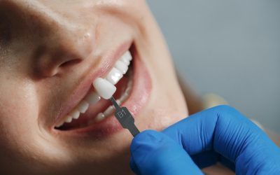 What to Expect When Getting Dental Veneers in Canley Heights