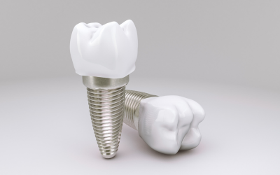 All You Need to Know About Dental Implants: A Comprehensive Guide from Canley Heights Dental Care